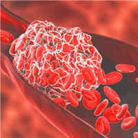 risk-of-serious-blood-clots-up-to-6-months-after-covid-19