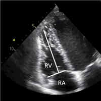 Semiquantitative Assessment of RFV with a Modified Subcostal Echocardiographic View