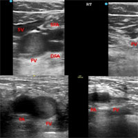 Spontaneous Echo Contrast in Venous Ultrasound of Severe COVID-19 Patients