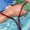 Subclavian vs. Femoral Arterial Cannulations During ECMO