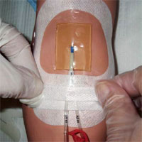 sustained-reduction-of-catheter-associated-bloodstream-infections-with-enhancement-of-catheter-bundle-by-chlorhexidine-dressings-over-11-years