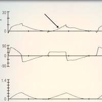 the-association-between-ventilator-dyssynchrony-delivered-tidal-volume-and-sedation-using-a-novel-automated-ventilator-dyssynchrony-detection-algorithm