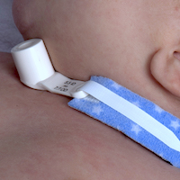 Timing of Tracheostomy in Pediatric Patients