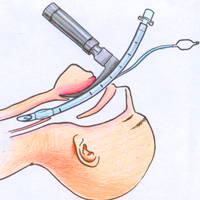 tracheal-intubation-practice-and-safety-across-international-picus