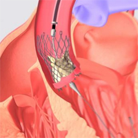 transcatheter-aortic-valve-replacement-in-younger-individuals