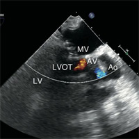 transient-systolic-anterior-motion-with-junctional-rhythm-after-mitral-valve-repair-in-the-icu