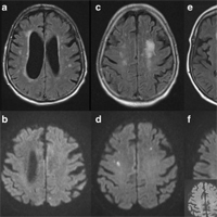 Translational Evidence for Two Distinct Patterns of Neuroaxonal Injury in Sepsis