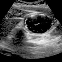 Ultrasound Assessment of Gastric Volume in Critically Ill Patients