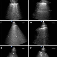 Ultrasound for Lung Monitoring of Ventilated Patients