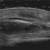 Ultrasound Grayscale Analysis in ARDS COVID-19