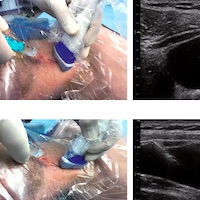 Ultrasound-guided Central Venous Catheter Placement
