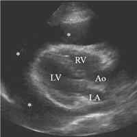 Use of Cardiac POCUS in Diagnosis of HFrEF in a Patient with Ischemic Stroke