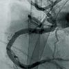 VA-ECMO to Rescue Sepsis-induced Cardiogenic Shock