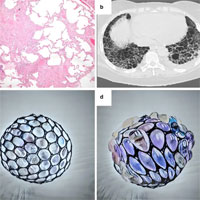 ventilatory-support-and-mechanical-properties-of-the-fibrotic-lung-acting-as-a-squishy-ball